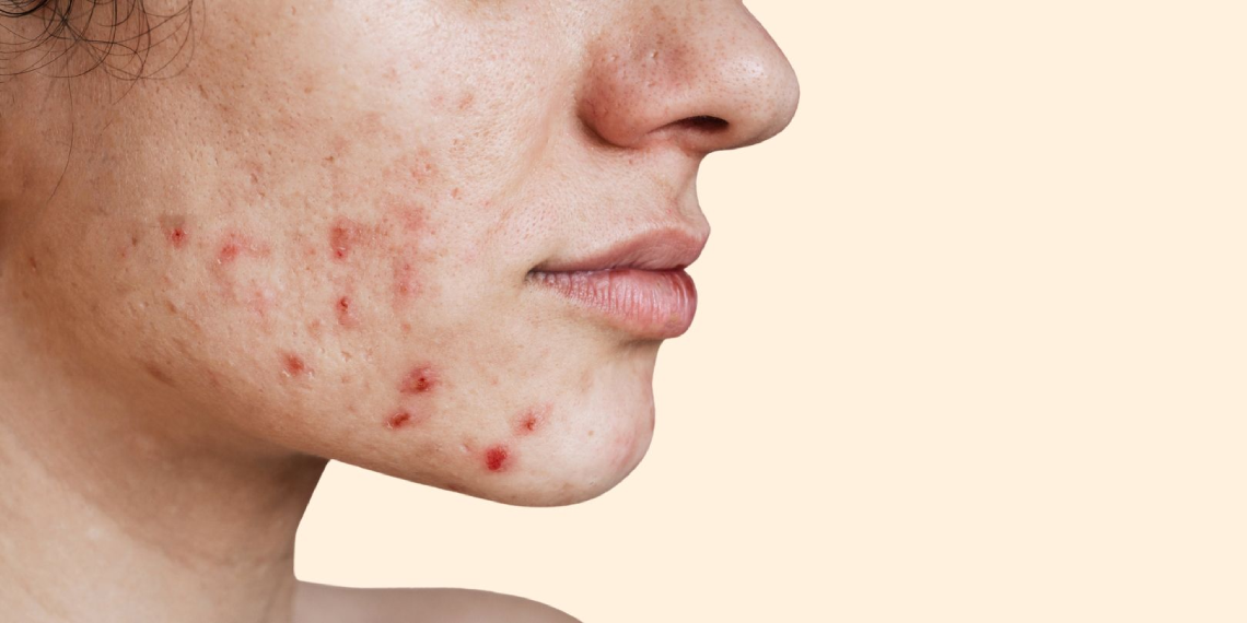 Why You're Breaking Out Even With a Good Skincare Routine — The Real Reasons