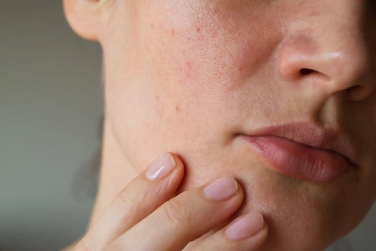 Why You're Breaking Out Even With a Good Skincare Routine — The Real Reasons